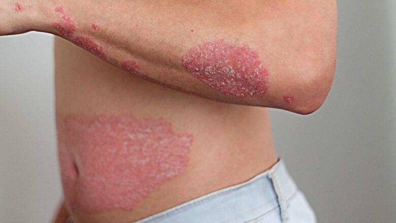 Time to Learn the Basics of Psoriasis