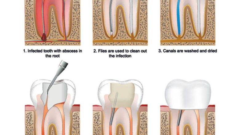 The Delicate Process of Conducting a Root Canal