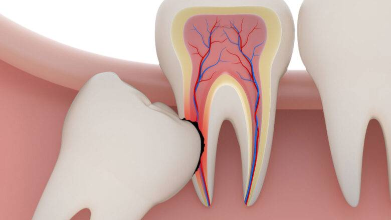 Wisdom Tooth Extraction: Why It’s Done and What to Do Post Surgery
