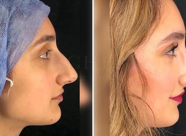 What is rhinoplasty and what you should know about it before you get it done?